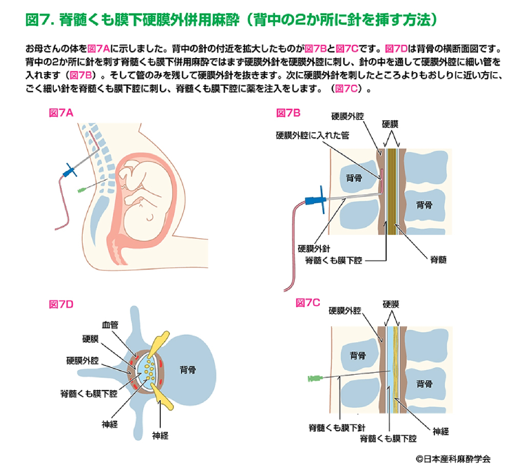 脊髄くも膜下硬膜外併用麻酔(背中の2か所に針を挿す方法)