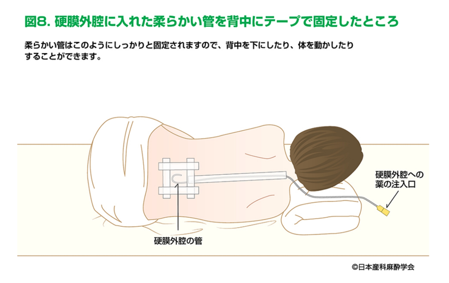 硬膜外膣に入れた柔らかい管を背中にテープで固定したところ