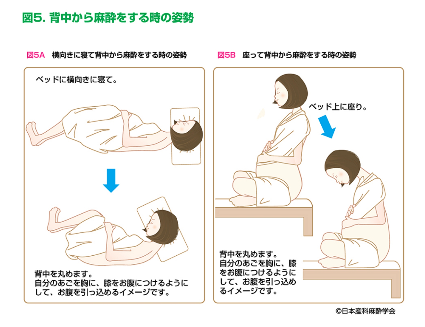 背中から麻酔をするときの姿勢